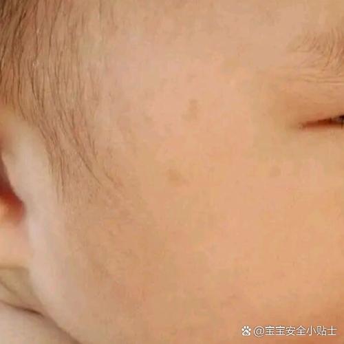 宝宝脸上一片黄一片白是怎么回事
