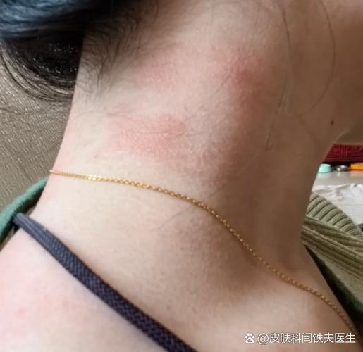 脖子红斑图片