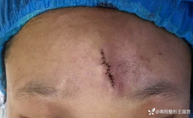 美容缝合三个月后图片