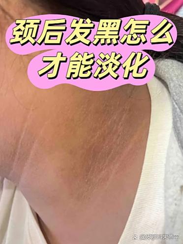 皮肤发黑是什么原因图标