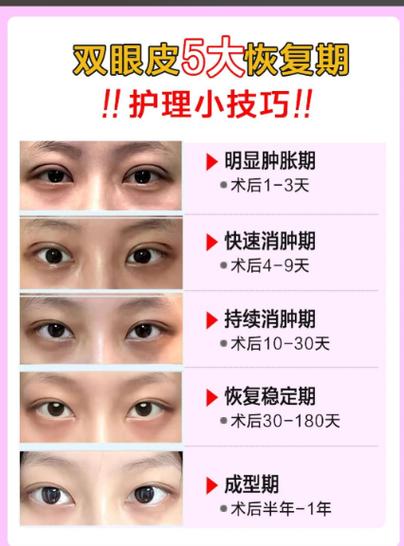 双眼皮三次修复的条件