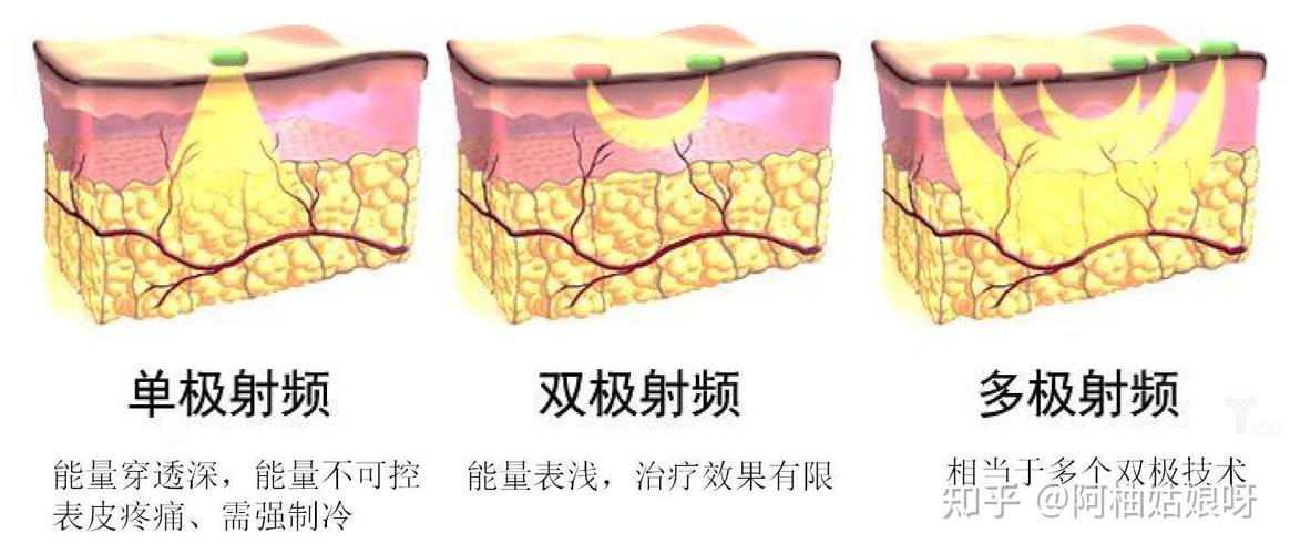 射频的作用和功效