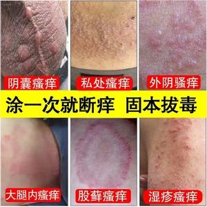 蛋皮痒怎么快速止痒