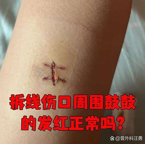 手术后疤痕发红鼓起来怎么办