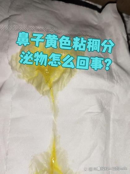 鼻子里老是有黄脓鼻涕图标