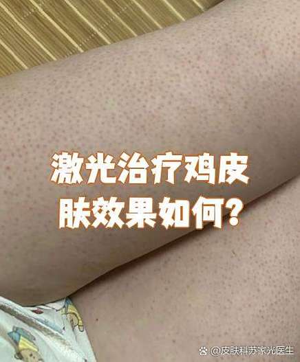 身体乳可以去鸡皮肤吗
