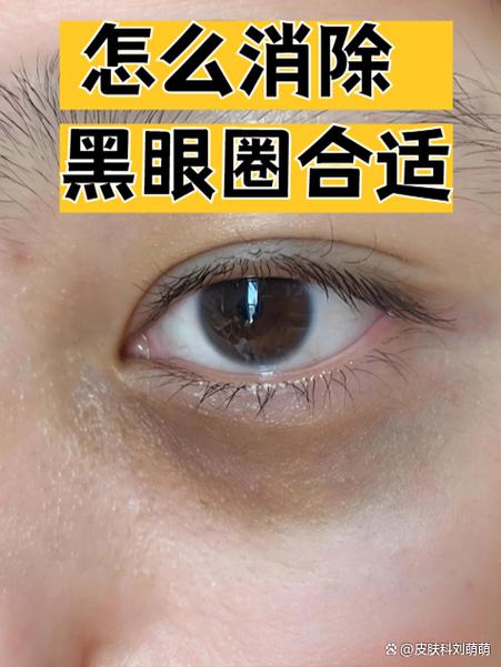 黑眼圈好重如何消除