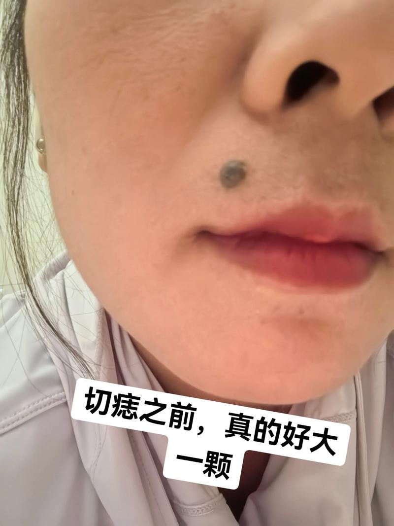 怎么把视频里的痣去掉