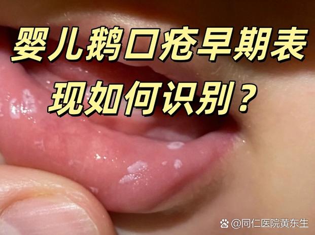 鹅口疮图片及症状
