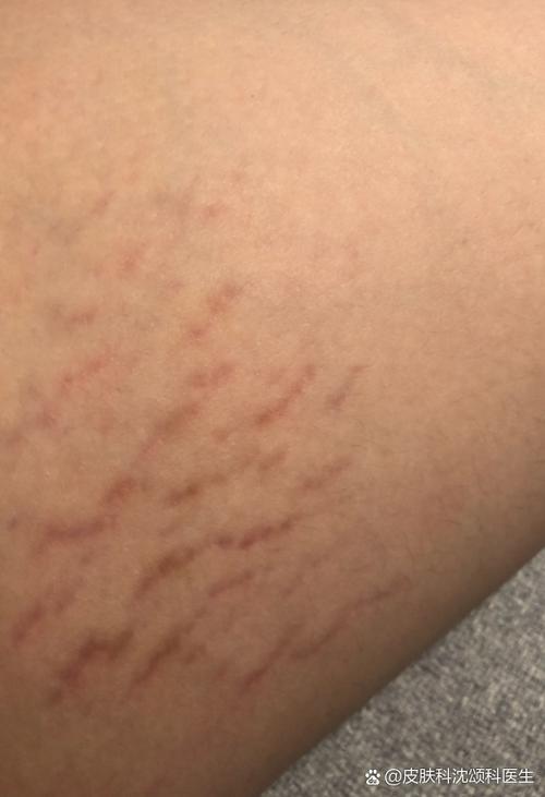 皮肤出现横纹是什么病