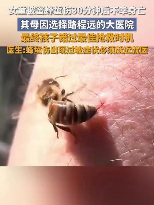 被大蜜蜂咬了