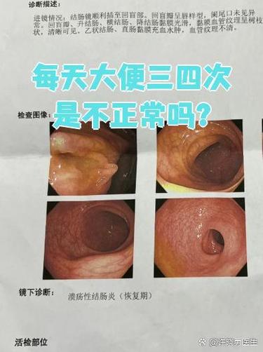 一天大便三四次正常吗