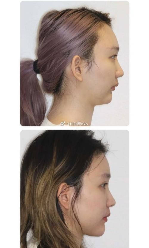 矫正牙齿嘴歪脸歪图