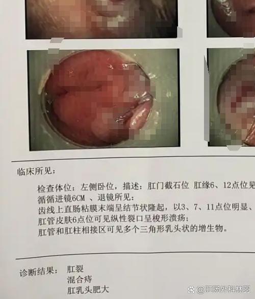 肛门旁边长了个包,按着疼,里面硬硬的