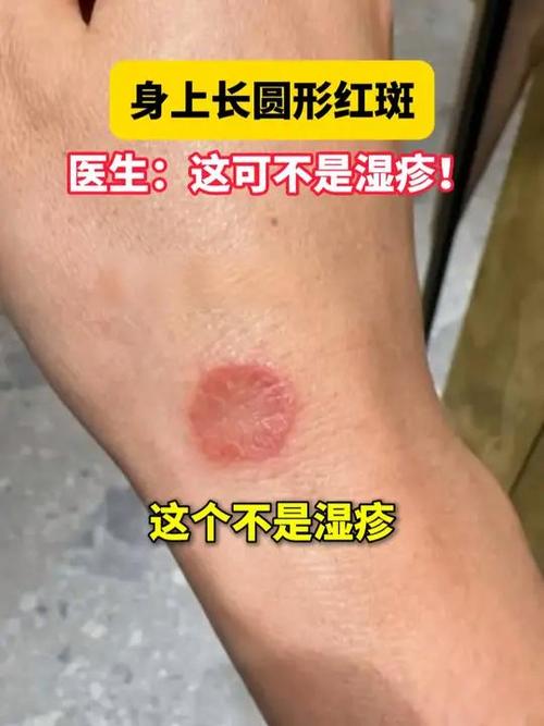 圆形红斑不痛不痒