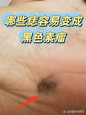 扫一扫识别痣