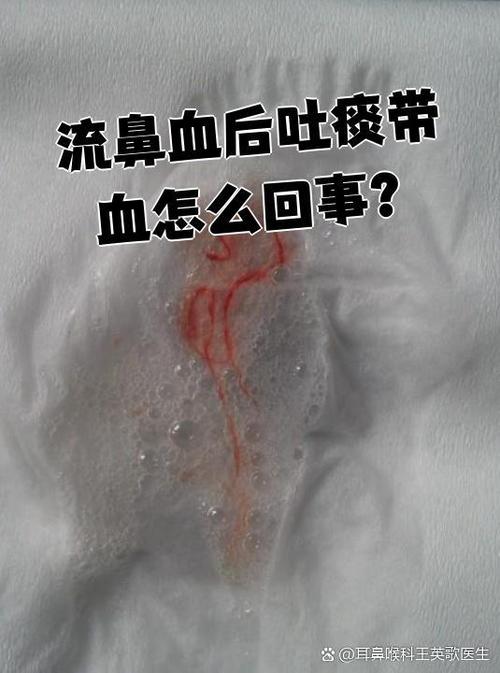鼻血不流了但是吐血痰