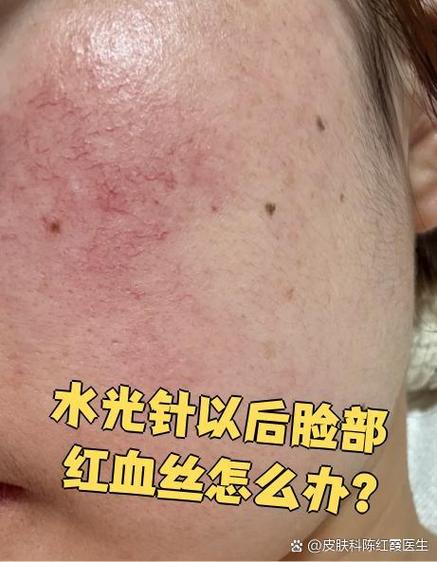 红血丝能做小气泡吗