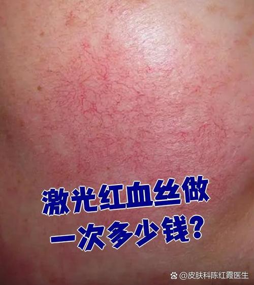 激光祛红血丝多少钱一次