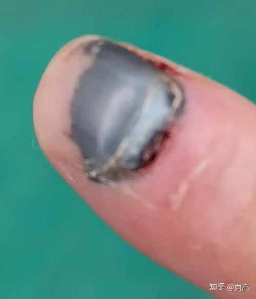 手指甲被夹了几天消肿