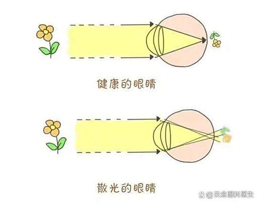 高散光可以矫正过来吗