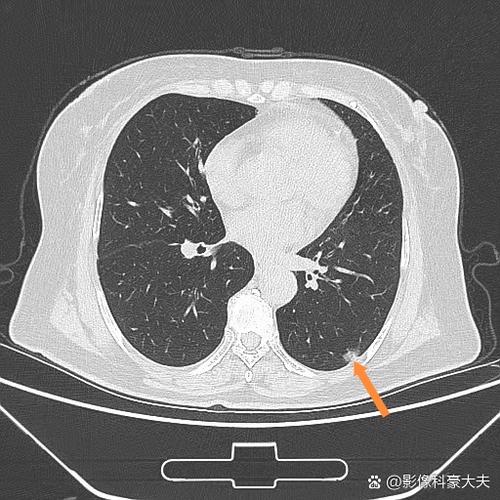 肺结节im104是多大