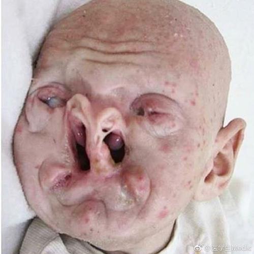 osas睡眠呼吸暂停综合征