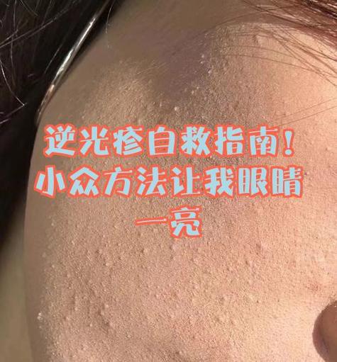 脸上逆光疹会自愈吗