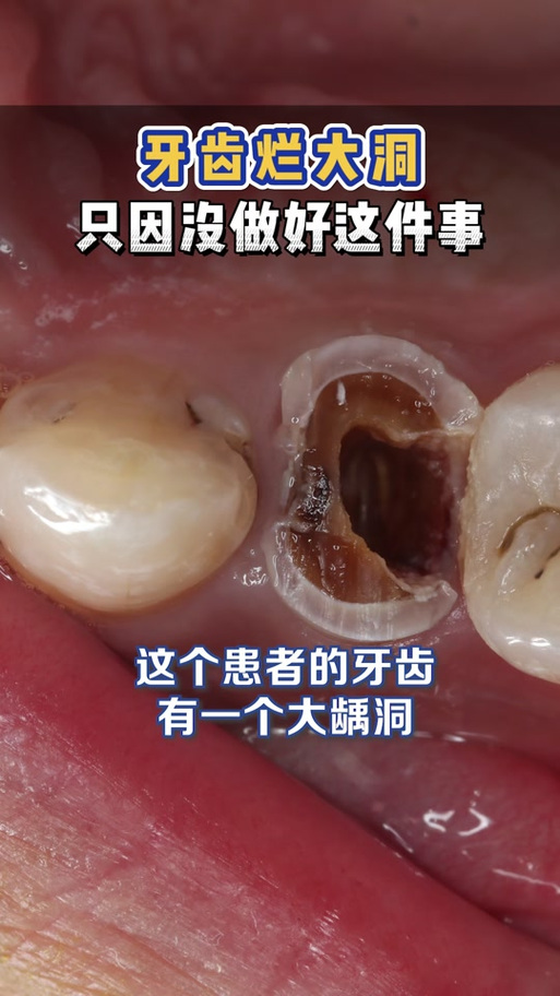 蛀牙烂了一半到底补还是拔