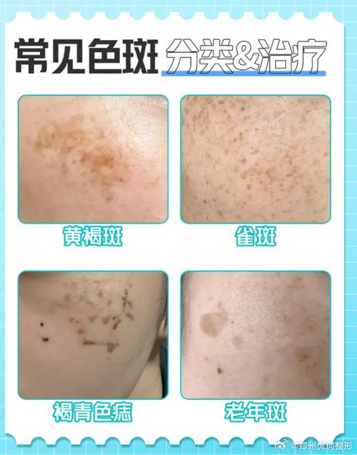 消除老年斑的最佳方法