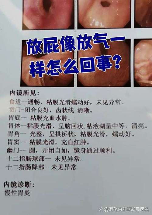 老是放气屁怎么回事