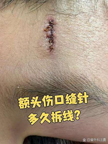 脸部美容手术线没拆干净截图