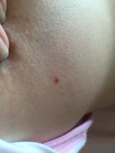 乳房上有小红点 像痣