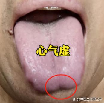双夏汤舌象