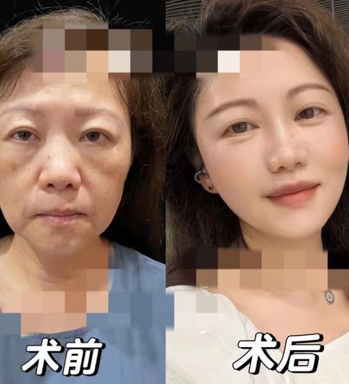 国内最好的拉皮术