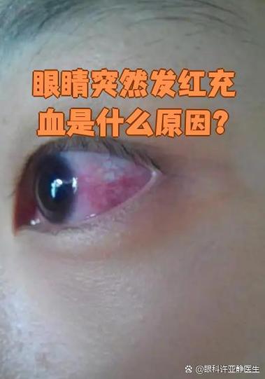 眼睛红有什么预兆
