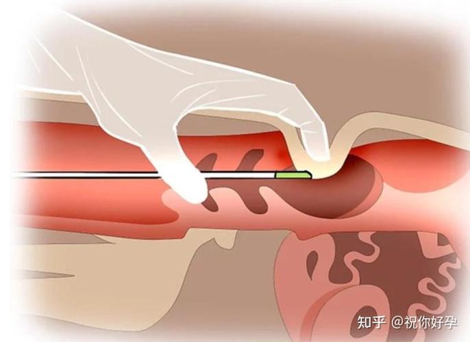 医院人工取精怎么取