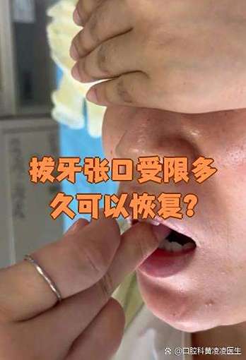 拔牙张口受限会自愈吗