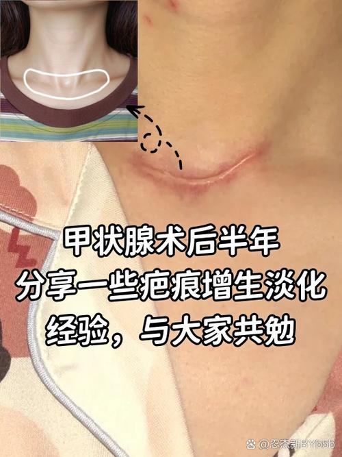 增生怎么样才能消除