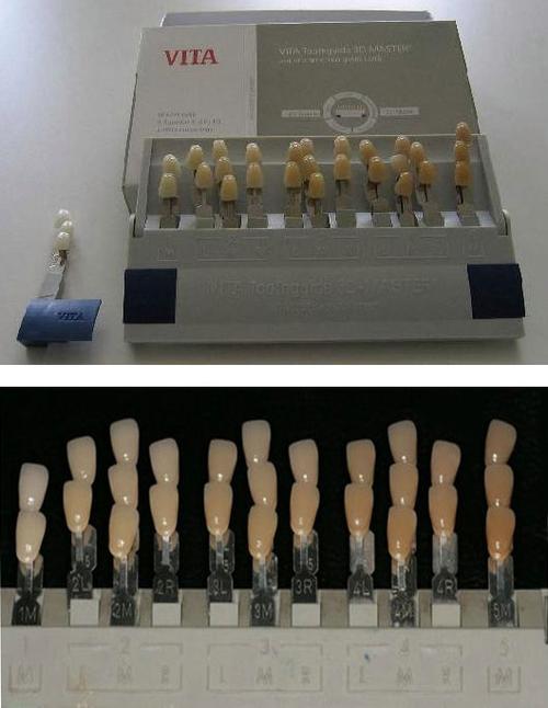 牙齿漂白多少钱一次