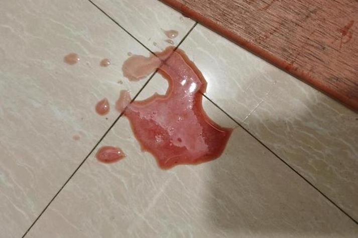 胃癌早期呕吐特点
