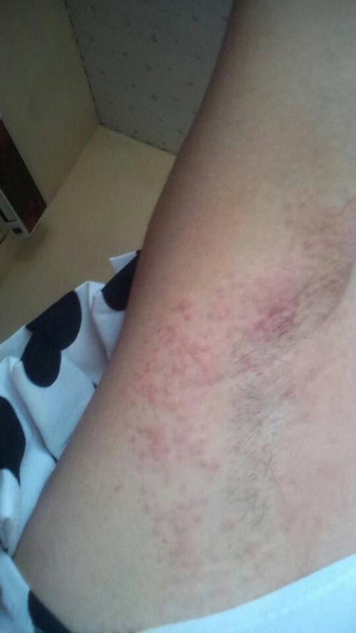 胳膊窝痒是怎么回事女性