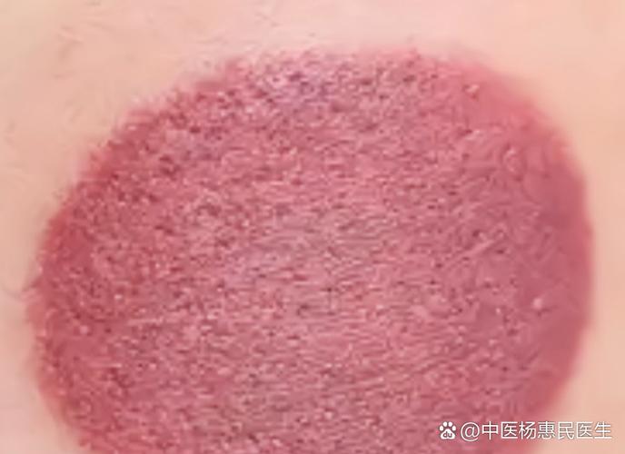 拔罐粉红色是怎么回事