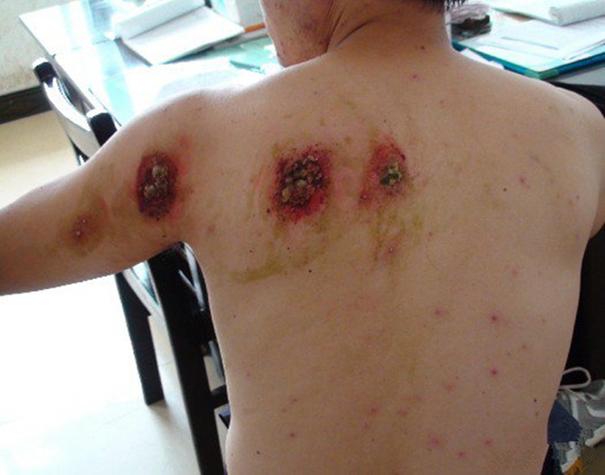 男人艾滋病的10个征兆