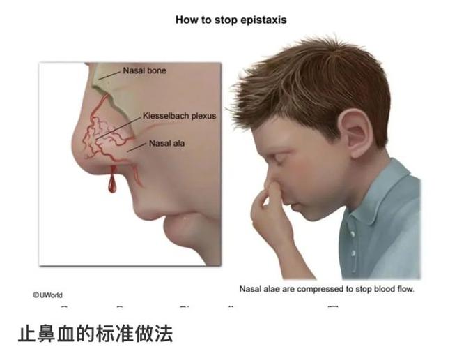 心火重流鼻血怎么办
