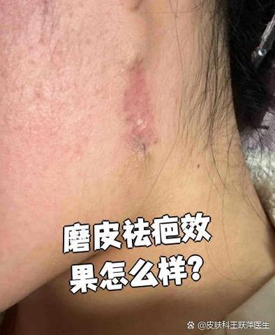 皮肤磨皮手术