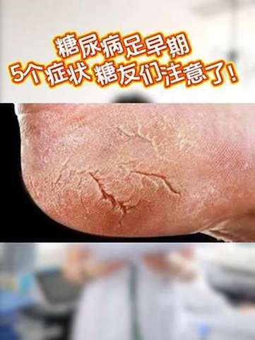 糖尿病的前兆