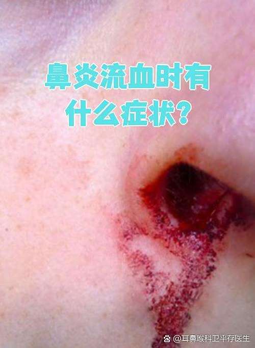 鼻腔焊接术后有流鼻血了