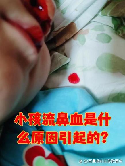 宝宝隔一个星期就流鼻血