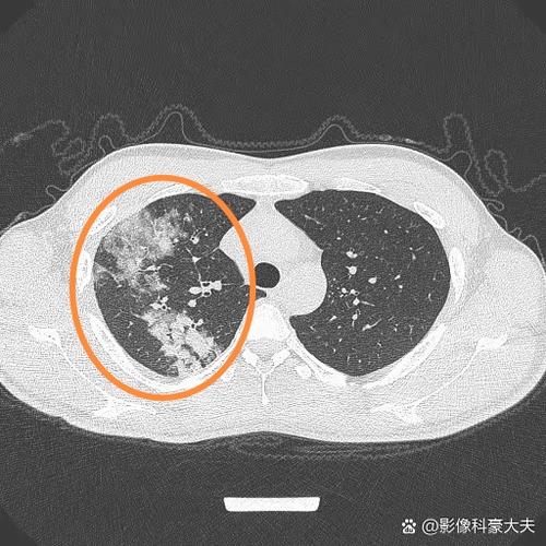 右肺下叶小气腔什么意思